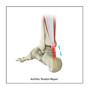 Achilles
												Tendon Repair