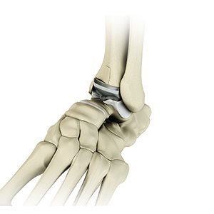 Ankle Joint Replacement