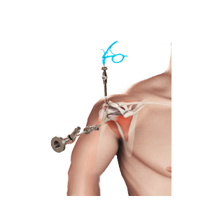 Arthroscopic Rotator Cuff Repair