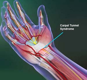 Carpal Tunnel Release Surgery