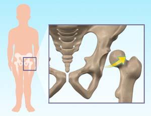  Developmental Dysplasia   