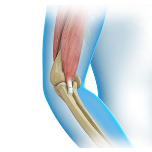 Elbow Tendon and Ligament Repair