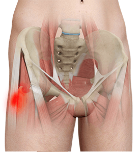  Hip Tendonitis   