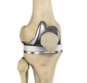 Jiffy Knee® Replacement