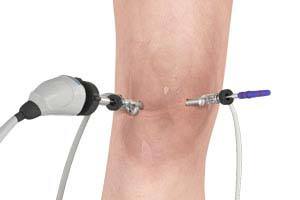  Knee Arthroscopy  