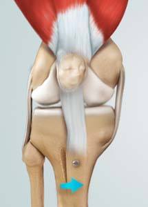  Knee Osteotomy  