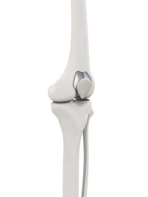  Patellofemoral Knee Replacement  