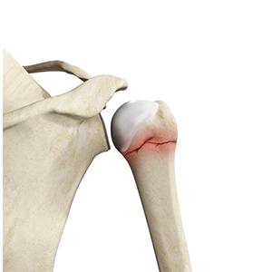 Proximal Humerus Fractures