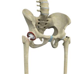  Revision Hip Replacement 