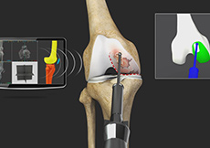 Partial Knee Replacement