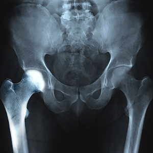 Transient Osteoporosis of the Hip