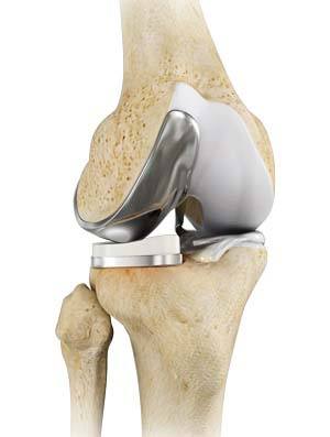  Unicompartmental Knee Replacement  